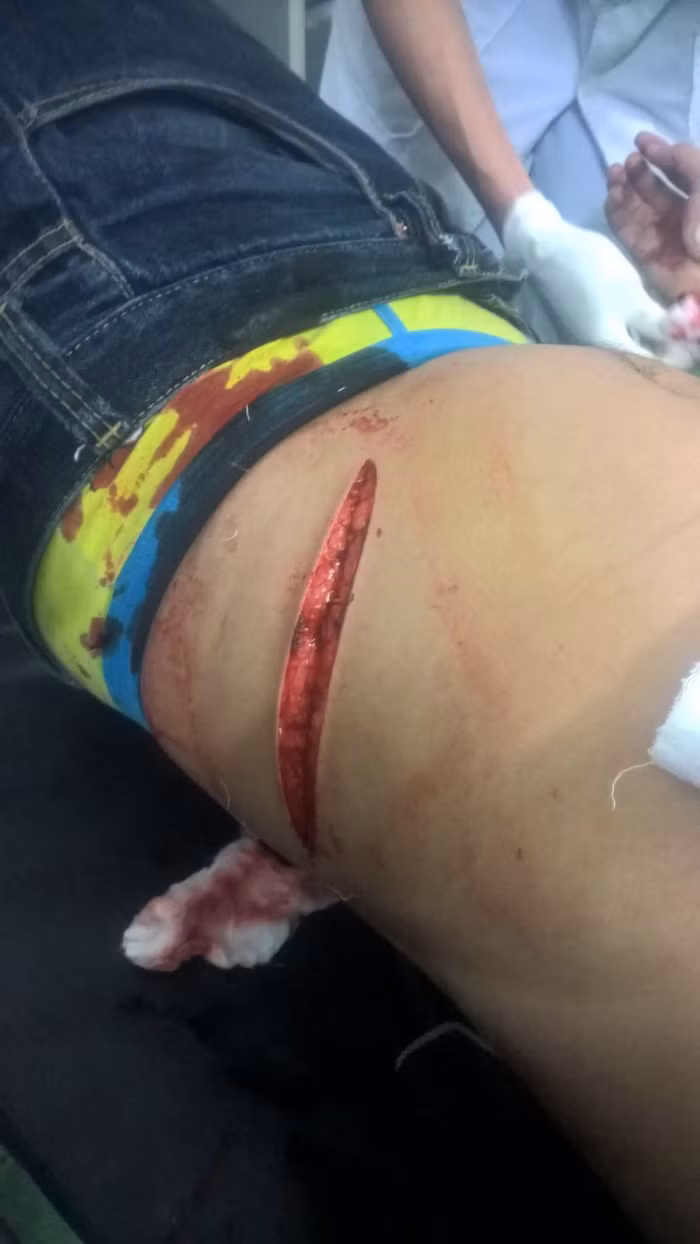 Hậu quả là Đạt bị một người thường được gọi là “Hai chỉ” (thuộc xe Hoàng Phương) đâm thẳng vào bụng, vết thương dài khoảng 20cm và sâu 5cm. Ảnh: gia đình nạn nhân cung cấp.