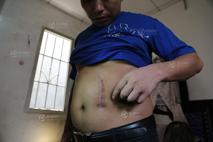 Đinh Hồng Tiến, vì nợ ngân hàng 20 ngàn tệ không có tiền thanh toán quyết định bán thận Đinh Hồng Tiến, vì nợ ngân hàng 20 ngàn tệ không có tiền thanh toán quyết định bán thận