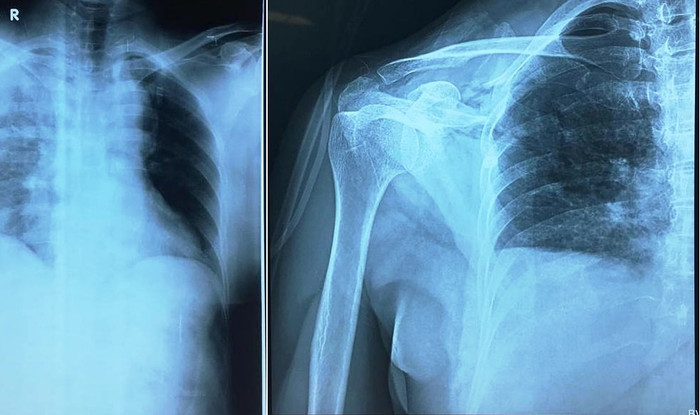 Ảnh chụp phim X - quang bệnh nhân (Ảnh: Bệnh viên đa khoa Đức Giang cung cấp) Ảnh chụp phim X - quang bệnh nhân (Ảnh: Bệnh viên đa khoa Đức Giang cung cấp)