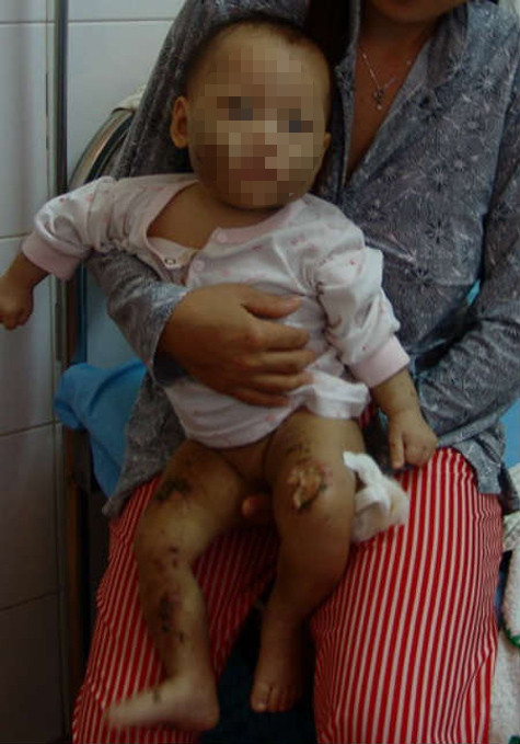 Hình ảnh bé Như Ý bị hành hạ đến tím tái