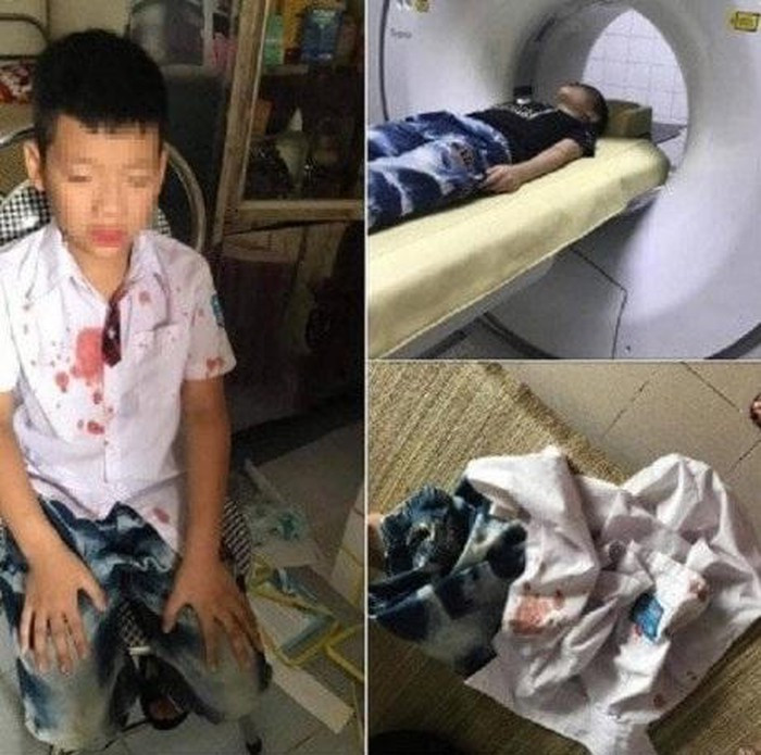 Hình ảnh đau lòng của bé K, ảnh: Báo Gia đình và Xã hội. Hình ảnh đau lòng của bé K, ảnh: Báo Gia đình và Xã hội.