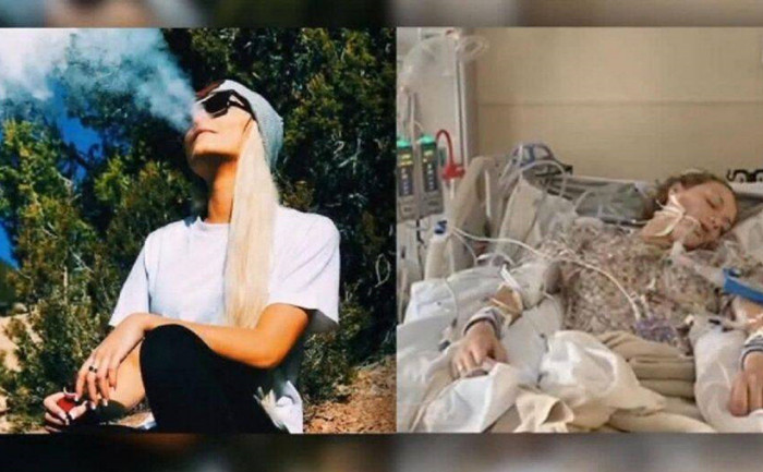 Một nan nhân của Vape. Ảnh FoxNews Một nan nhân của Vape. Ảnh FoxNews