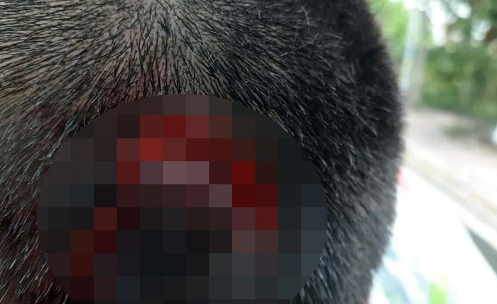 Vết thương trên đầu của em Nguyễn Quốc An (đã đổi tên nhân vật). (Ảnh: L.T) Vết thương trên đầu của em Nguyễn Quốc An (đã đổi tên nhân vật). (Ảnh: L.T)