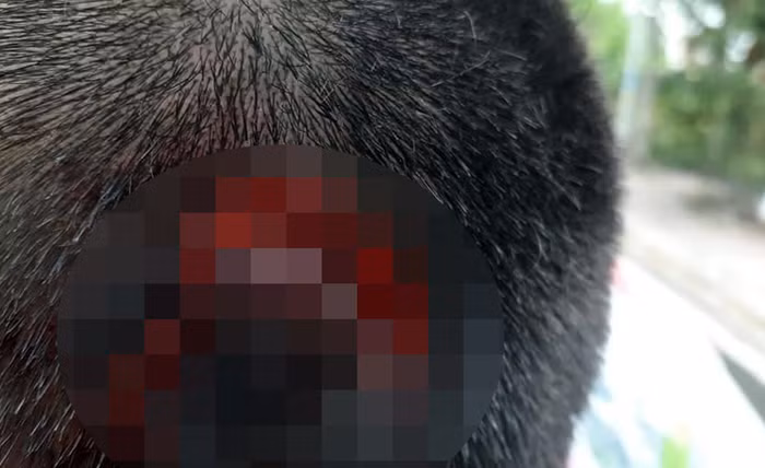 Vết thương trên đầu của em Nguyễn Quốc An (đã đổi tên nhân vật). (Ảnh: L.T)