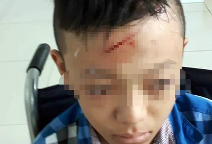 Học sinh bị bạn đánh rách da đầu. (Ảnh. L.T) Học sinh bị bạn đánh rách da đầu. (Ảnh. L.T)