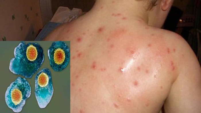 Virut Varicella zoster gây bệnh thủy đậu (ảnh nhỏ) và tổn thương do thủy đậu trên da (ảnh lớn) . Virut Varicella zoster gây bệnh thủy đậu (ảnh nhỏ) và tổn thương do thủy đậu trên da (ảnh lớn) .
