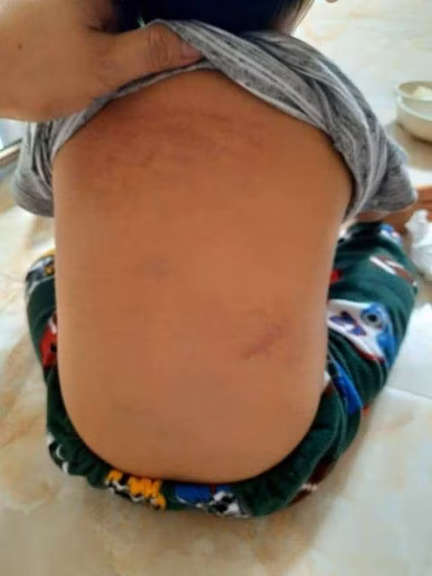 Hình ảnh bầm tím trên người cháu H. được chia sẻ trên mạng