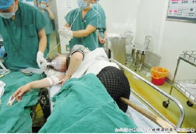 Chị Cao bị chiếc gậy xuyên dọc người khi được đưa đến bệnh viện Chị Cao bị chiếc gậy xuyên dọc người khi được đưa đến bệnh viện