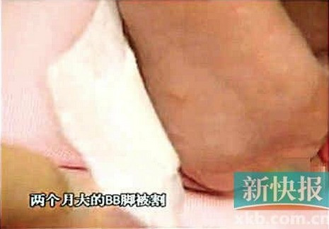 Một em bé khác cũng bị đối tượng biến thái này dùng dao lam rạch gót chân Một em bé khác cũng bị đối tượng biến thái này dùng dao lam rạch gót chân