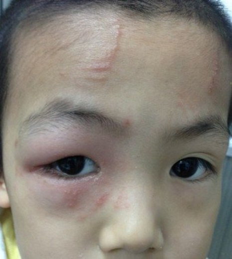 Một bệnh nhân bị viêm da tiếp xúc do côn trùng. Một bệnh nhân bị viêm da tiếp xúc do côn trùng.