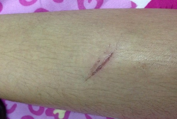 Vết thương ở chân của thiếu nữ Y., cô cho rằng, trong quá trình chống cự lại hành vi hiếp dâm của đại gia Huy, ngoài việc cô cắn vào môi ông Huy, cô còn bị thương và bầm tím ở chân. Ảnh thiếu nữ Y. cung cấp. Vết thương ở chân của thiếu nữ Y., cô cho rằng, trong quá trình chống cự lại hành vi hiếp dâm của đại gia Huy, ngoài việc cô cắn vào môi ông Huy, cô còn bị thương và bầm tím ở chân. Ảnh thiếu nữ Y. cung cấp.