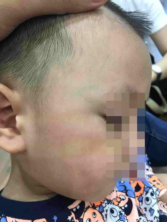 Má bé có vết đỏ. Ảnh gia đình cung cấp Má bé có vết đỏ. Ảnh gia đình cung cấp