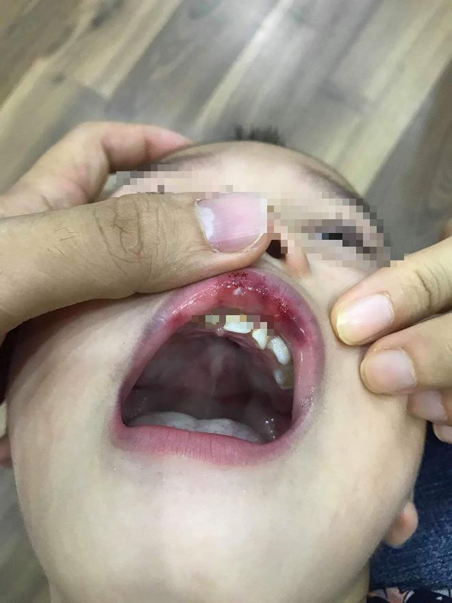 Phần miệng bé bầm tím. Ảnh: Gia đình cung cấp Phần miệng bé bầm tím. Ảnh: Gia đình cung cấp