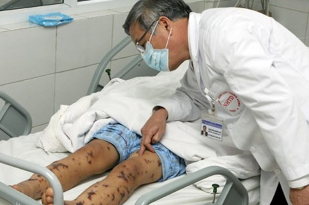 Bệnh viêm não mô cầu vô cùng nguy hiểm. (Ảnh minh họa: Dân Việt)