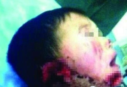 Nạn nhân bị chính thím dâu của mình cắt đứt đôi tai và chém đứt cằm. Bức ảnh nạn nhân đang lan tràn trên mạng internet tại Trung Quốc gây ra cơn phẫn nộ, kinh hoàng trong dư luận.