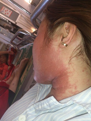 Bệnh nhân dị ứng mỹ phẩm phải điều trị tại Bệnh viện Bạch Mai, Hà Nội.