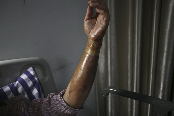 Bỏng cả cánh tay vì pháo hoa Bỏng cả cánh tay vì pháo hoa