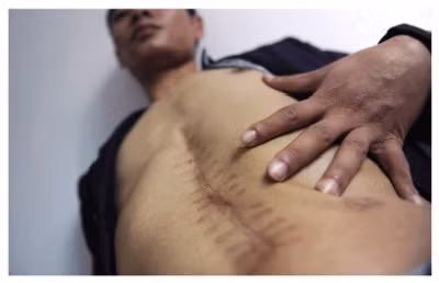 Sẹo sau mổ trên cơ thể Lưu Dũng, người cáo buộc mình bị bác sĩ tự ý cắt mất thận trái