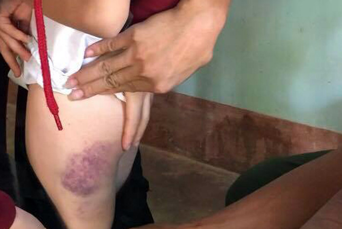 Học sinh bị giáo viên đánh bầm mông. (Ảnh: H.L) Học sinh bị giáo viên đánh bầm mông. (Ảnh: H.L)