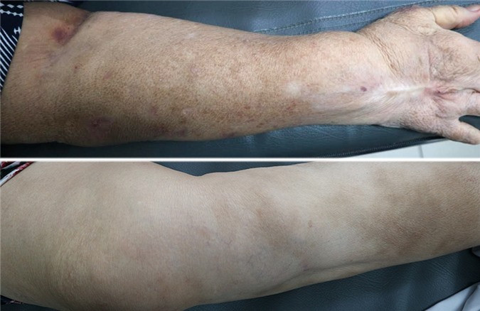 Dấu hiệu sạm da và những vết bầm rải rác ở bệnh nhân bị tác dụng phụ của corticoid. Ảnh minh họa. Dấu hiệu sạm da và những vết bầm rải rác ở bệnh nhân bị tác dụng phụ của corticoid. Ảnh minh họa.