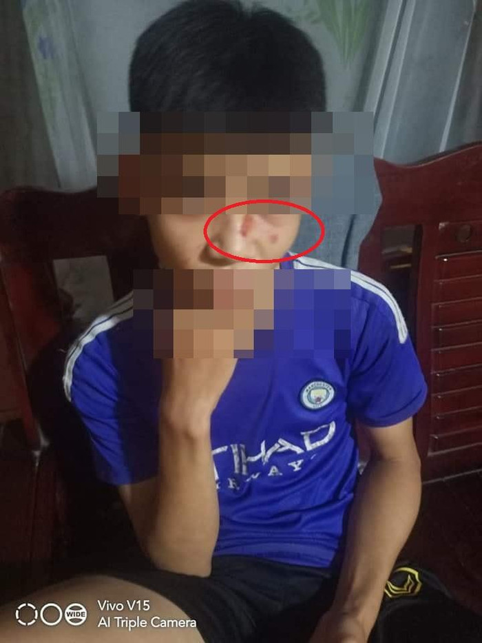 Vết xước do móng tay của thầy Bùi Văn T. để lại trên mặt học sinh Hà Văn M. Vết xước do móng tay của thầy Bùi Văn T. để lại trên mặt học sinh Hà Văn M.