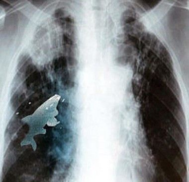 Phim chụp X - quang cho thấy hình ảnh một chú cá sống bị mắc kẹt trong phổi cậu bé. Ảnh: The Sun.