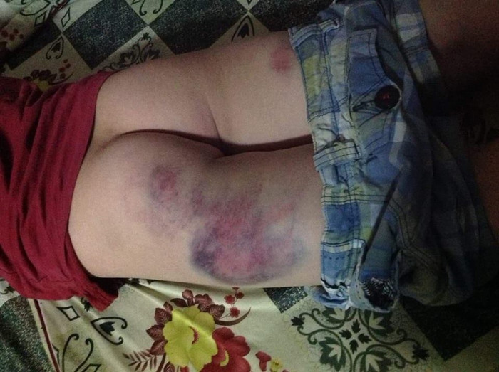 Con bị trầy xước khi đi học, phụ huynh đòi bồi thường 100 triệu đồng ảnh 2 Con bị trầy xước khi đi học, phụ huynh đòi bồi thường 100 triệu đồng ảnh 2