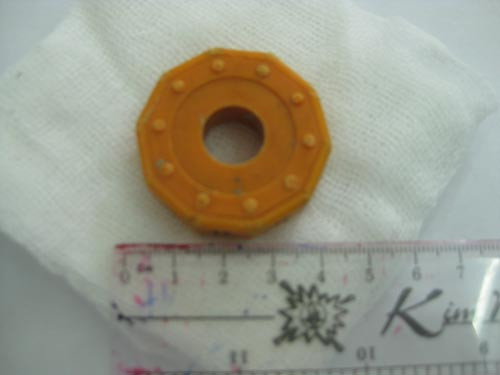 Dị vật có đường kính 4 cm mắc kẹt trong thực quản bệnh nhi. Ảnh: Bệnh viện Nhi Đồng 2.