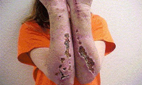 Ma túy đá phá hủy làn da.