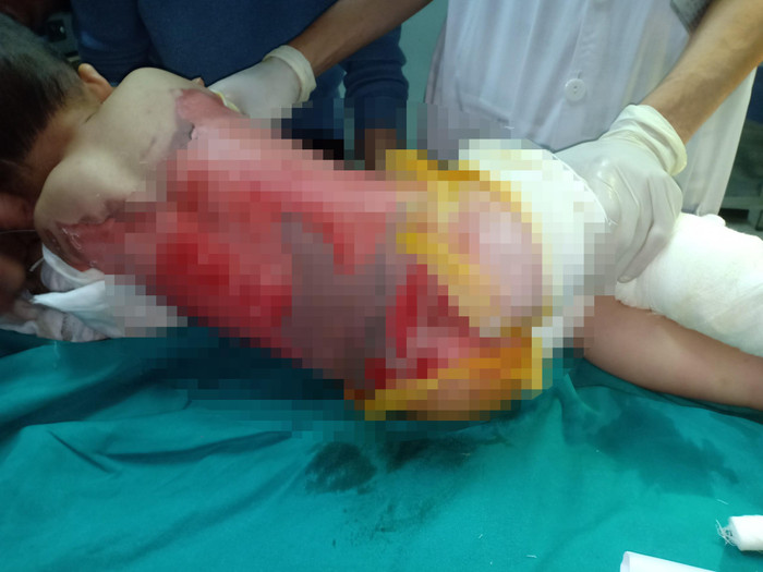 Các bác sĩ cảnh báo tuyệt đối không nên tự ý sử dụng thảo dược (không rõ nguồn gốc) để cấp cứu và tự “chữa” bỏng cho trẻ. (Ảnh: Bệnh viện đa khoa Tuyên Quang cung cấp) Các bác sĩ cảnh báo tuyệt đối không nên tự ý sử dụng thảo dược (không rõ nguồn gốc) để cấp cứu và tự “chữa” bỏng cho trẻ. (Ảnh: Bệnh viện đa khoa Tuyên Quang cung cấp)