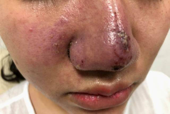 Một trường hợp bị biến chứng do tiêm chất làm đầy. Một trường hợp bị biến chứng do tiêm chất làm đầy.