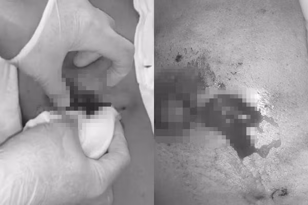 Ngực bệnh nhân liên tục chảy mủ sau khi tiêm filler. Ngực bệnh nhân liên tục chảy mủ sau khi tiêm filler.