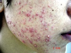 Hãi hùng sau khi tẩy da chết. Ảnh minh họa.