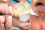 Cách phát hiện sớm và chăm sóc trẻ bị tay chân miệng