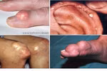 Bệnh gout, không nên ăn gì?