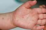 Cảnh báo dịch bệnh tay chân miệng vào mùa gây nguy hiểm cho trẻ nhỏ 