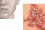16 dấu hiệu có thể bạn bị nhiễm HIV
