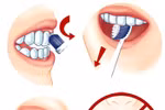 Điều trị mòn răng khó hay dễ?
