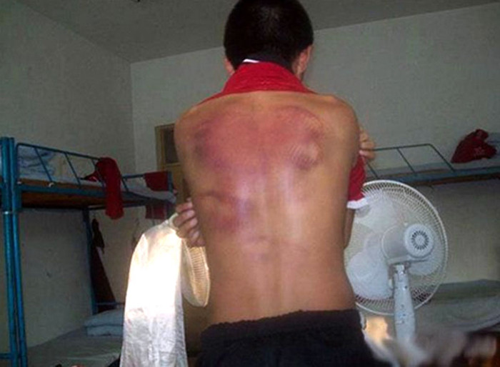 Những vết đánh vẫn hằn nguyên trên cơ thể. >> RỚT NƯỚC MẮT VÌ ƯỚC MUỐN GIẢN DỊ CỦA NHỮNG ĐỨA TRẺ BỊ ĐÒN ROI >> NHỮNG TRÒ QUÁI CHIÊU CỦA SINH VIÊN TRUNG QUỐC Những vết đánh vẫn hằn nguyên trên cơ thể. >> RỚT NƯỚC MẮT VÌ ƯỚC MUỐN GIẢN DỊ CỦA NHỮNG ĐỨA TRẺ BỊ ĐÒN ROI >> NHỮNG TRÒ QUÁI CHIÊU CỦA SINH VIÊN TRUNG QUỐC