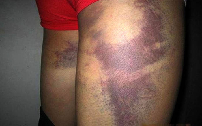 Một giáo viên giấu tên trong trường cho biết: "Đối với các trường quân sự, chúng tôi gặp khó khăn nhiều hơn trong việc quản lý cũng như giáo dục đạo đức cho các em. Đây là cách trừng phạt nhanh nhất và hiệu quả nhất khiến các em phải nhớ thật lâu về những lỗi lầm mình đã mắc phải và không để tái hiện lần sau". >> RỚT NƯỚC MẮT VÌ ƯỚC MUỐN GIẢN DỊ CỦA NHỮNG ĐỨA TRẺ BỊ ĐÒN ROI >> NHỮNG TRÒ QUÁI CHIÊU CỦA SINH VIÊN TRUNG QUỐC Một giáo viên giấu tên trong trường cho biết: "Đối với các trường quân sự, chúng tôi gặp khó khăn nhiều hơn trong việc quản lý cũng như giáo dục đạo đức cho các em. Đây là cách trừng phạt nhanh nhất và hiệu quả nhất khiến các em phải nhớ thật lâu về những lỗi lầm mình đã mắc phải và không để tái hiện lần sau". >> RỚT NƯỚC MẮT VÌ ƯỚC MUỐN GIẢN DỊ CỦA NHỮNG ĐỨA TRẺ BỊ ĐÒN ROI >> NHỮNG TRÒ QUÁI CHIÊU CỦA SINH VIÊN TRUNG QUỐC