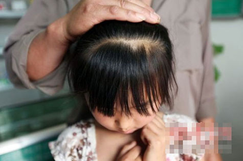 Bé Đô Đô bị giật đứt mất 2 túm tóc khá lớn trên đầu. Bé Đô Đô bị giật đứt mất 2 túm tóc khá lớn trên đầu.