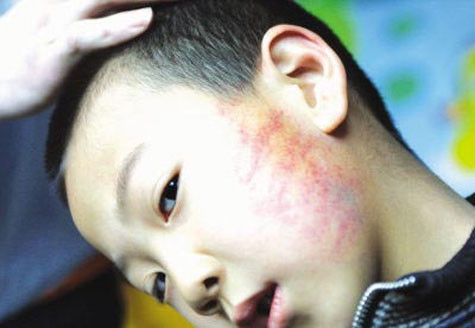 Tiểu Vũ bị tát 30 cái vì nhổ nước bọt không may bị dính lên người cô giáo. Tiểu Vũ bị tát 30 cái vì nhổ nước bọt không may bị dính lên người cô giáo.