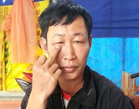 Do bị xịt hơi cay vào mặt ở vị trí gần nên đã hơn 1 tháng nhưng mắt phải anh Hậu vẫn đang sưng tấy, mờ và không dám nhìn ánh sáng ngoài trời vì bị choáng Do bị xịt hơi cay vào mặt ở vị trí gần nên đã hơn 1 tháng nhưng mắt phải anh Hậu vẫn đang sưng tấy, mờ và không dám nhìn ánh sáng ngoài trời vì bị choáng