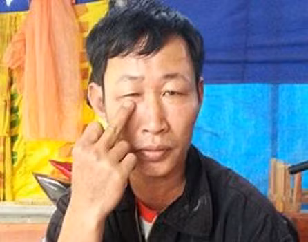 Do bị xịt hơi cay vào mặt ở vị trí gần nên đã hơn 1 tháng nhưng mắt phải anh Hậu vẫn đang sưng tấy, mờ và không dám nhìn ánh sáng ngoài trời vì bị choáng