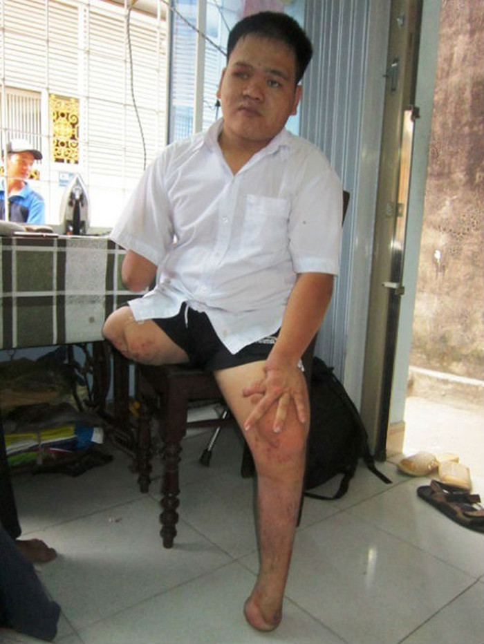 Nghị lực phi thường của thí sinh Hồ Văn Lai quê ở Quảng Trị dự thi vào Trường Đại học Đà Nẵng. Ít ai biết rằng, để thực hiện được giấc mơ vào đại học cháy bỏng của mình, nhiều năm qua, với nghị lực phi thường, cậu học trò từng là nạn nhân của bom mìn chiến tranh đã đấu tranh, nỗ lực không biết mệt mỏi. Nghị lực phi thường của thí sinh Hồ Văn Lai quê ở Quảng Trị dự thi vào Trường Đại học Đà Nẵng. Ít ai biết rằng, để thực hiện được giấc mơ vào đại học cháy bỏng của mình, nhiều năm qua, với nghị lực phi thường, cậu học trò từng là nạn nhân của bom mìn chiến tranh đã đấu tranh, nỗ lực không biết mệt mỏi.