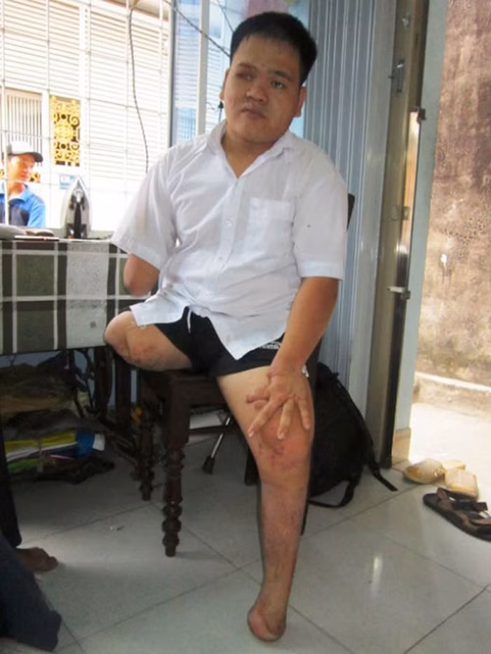 Nghị lực phi thường của thí sinh Hồ Văn Lai quê ở Quảng Trị dự thi vào Trường Đại học Đà Nẵng. Ít ai biết rằng, để thực hiện được giấc mơ vào đại học cháy bỏng của mình, nhiều năm qua, với nghị lực phi thường, cậu học trò từng là nạn nhân của bom mìn chiến tranh đã đấu tranh, nỗ lực không biết mệt mỏi. Nghị lực phi thường của thí sinh Hồ Văn Lai quê ở Quảng Trị dự thi vào Trường Đại học Đà Nẵng. Ít ai biết rằng, để thực hiện được giấc mơ vào đại học cháy bỏng của mình, nhiều năm qua, với nghị lực phi thường, cậu học trò từng là nạn nhân của bom mìn chiến tranh đã đấu tranh, nỗ lực không biết mệt mỏi.