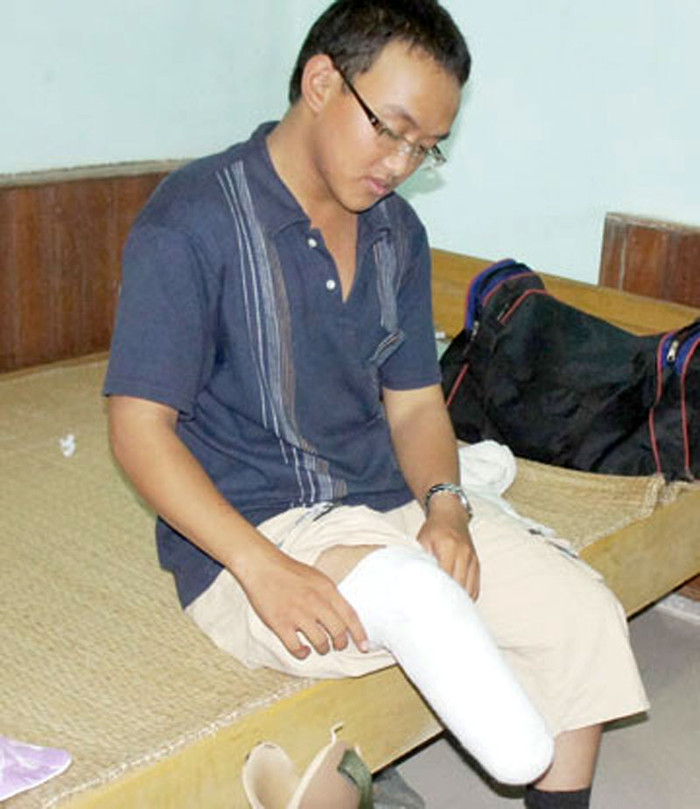 Thí sinh Lê Hà Tiền quê ở xã Quỳnh Lập, Quỳnh Lưu,Nghệ An dự thi vào ĐH Vinh. Trong ảnh Hiền đang quấn vải vào khúc chân phải để ráp chân giả vào đến phòng thi cho bớt đau. Thí sinh Lê Hà Tiền quê ở xã Quỳnh Lập, Quỳnh Lưu,Nghệ An dự thi vào ĐH Vinh. Trong ảnh Hiền đang quấn vải vào khúc chân phải để ráp chân giả vào đến phòng thi cho bớt đau.