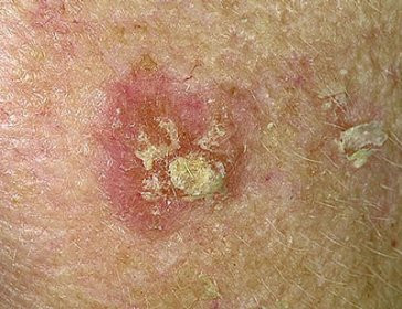 Vì vậy, khi thấy có hiện tượng mẩn ngứa hoặc viêm da, phải đi khám ngay ở các bệnh viện chuyên môn. Xem thêm: Bí quyết "nhỏ", giữ sức khỏe "lớn" trong mùa nắng nóng