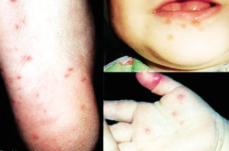 Hồ bơi là nơi các trẻ tập trung mật độ cao, nếu tiếp xúc trực tiếp thì nguy cơ lây nhiễm cao hơn, virus TCM có thể nhiễm vào nước rồi đi vào miệng trẻ khác nhưng khó khăn hơn vì nước hồ bơi luôn có chứa chất sát khuẩn. Xem thêm: Bí quyết "nhỏ", giữ sức khỏe "lớn" trong mùa nắng nóng