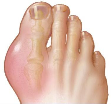 Sỏi và Gout: Tư liệu liên quan còn chứng minh, người mắc bệnh viêm dạ dày do thu co, hệ thống tiết niệu kết sỏi…, nếu uống bia quá nhiều sẽ làm cho bệnh cũ tái phát hoặc làm bệnh tình nặng thêm. Đấy là do trong mầm đại mạch ủ bia hàm chứa can-xi, oxalic, nucleotide và purine nucleotide... những chất này tác dụng lẫn nhau, làm cho lượng niệu toan trong cơ thể tăng lên gấp đôi, không những thúc đẩy hình thành nên sỏi mật, sỏi thận mà còn gây ra bệnh Gout. Xem thêm:Nhận diện mụn và phương cách "cạch mặt" chúng Sỏi và Gout: Tư liệu liên quan còn chứng minh, người mắc bệnh viêm dạ dày do thu co, hệ thống tiết niệu kết sỏi…, nếu uống bia quá nhiều sẽ làm cho bệnh cũ tái phát hoặc làm bệnh tình nặng thêm. Đấy là do trong mầm đại mạch ủ bia hàm chứa can-xi, oxalic, nucleotide và purine nucleotide... những chất này tác dụng lẫn nhau, làm cho lượng niệu toan trong cơ thể tăng lên gấp đôi, không những thúc đẩy hình thành nên sỏi mật, sỏi thận mà còn gây ra bệnh Gout. Xem thêm:Nhận diện mụn và phương cách "cạch mặt" chúng